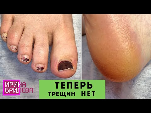 Видео: ПЕДИКЮР 🌸 Как избавиться от трещин??? 🌸 Правильный уход за ногами 🌸 Ирина Брилёва