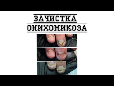 Видео: Зачистка грибка ногтей. Зачистка Онихомикоза! Работа Подолога! Грибок ногтей! 