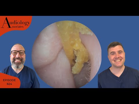 Видео: Удовлетворительная лента для кожи и еще 2 процедуры по удалению ушной серы - EP824