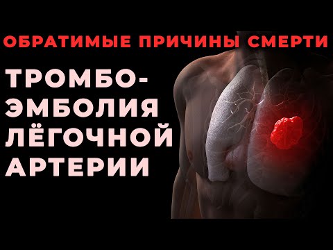 Видео: Тромбоэмболия лёгочной артерии как обратимая причина клинической смерти #ПроСМП