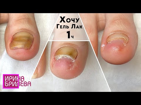 Видео: Педикюр 🌸 Хочу покрыть ногти гель лаком! 🌸 Что бывает, если не лечить ногти 🌸 Ирина Брилёва