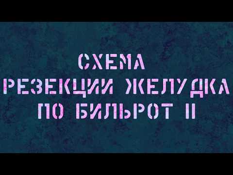 Видео: Схема резекции желудка по Бильрот II