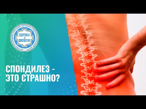Видео: 🤷 Спондилез - это страшно?