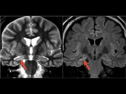 Видео: Эпилепсия у детей. Как и для чего мы делаем МРТ?