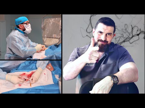 Видео: Эмболизация аневризм артерий головного мозга. Часть 1