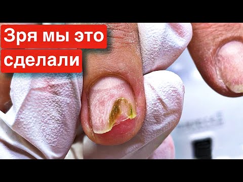 Видео: Плесень на ногтях или травматичный онихолизис. Сложные руки.