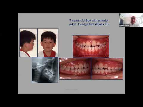 Видео: Уебинар - От подредени зъби към стабилна оклузия: какво пропускаме в ортодонтското лечение?