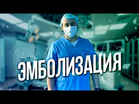 Видео: Эмболизация маточных артерий