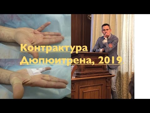 Видео: Лечение контрактуры Дюпюитрена. Что делать, если постепенно сгибаются пальцы?