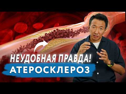 Видео: Правда об АТЕРОСКЛЕРОЗЕ, которую редко говорят! // ХОЛЕСТЕРИНОВЫЕ БЛЯШКИ // #чжудши