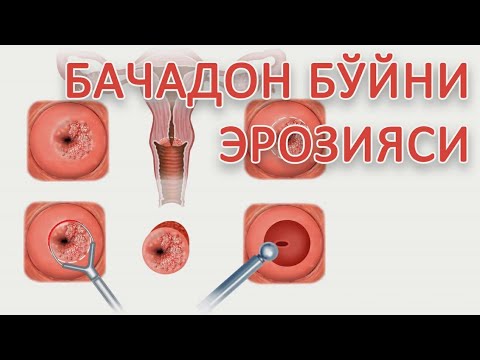 Видео: БАЧАДОН БЎЙНИ ЭРОЗИЯСИ: сабаблари, белгилари, даволаш