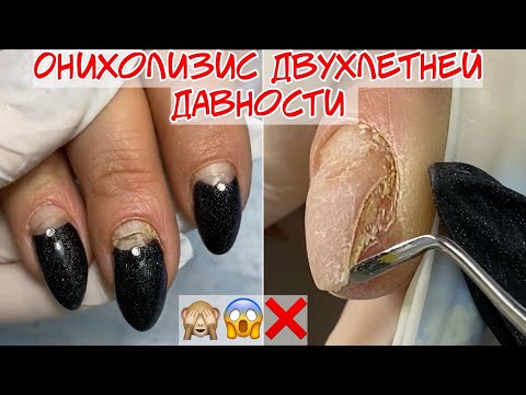 Видео: Онихолизис ногтей двухлетней давности 😱❌