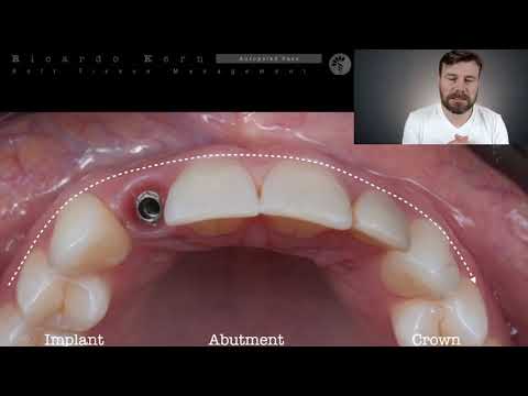Видео: Лечение дефектов периимплантных тканей. Видео 1 (на английском языке)