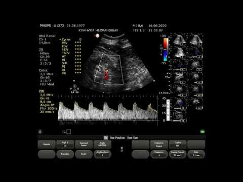 Видео: УЗИ сосудов почек норма 2020 06 16 11 21 30