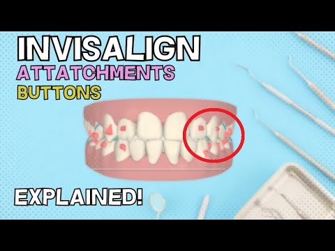 Видео: Крепления и кнопки Invisalign | Как они работают? - Объясняем за 4 минуты!