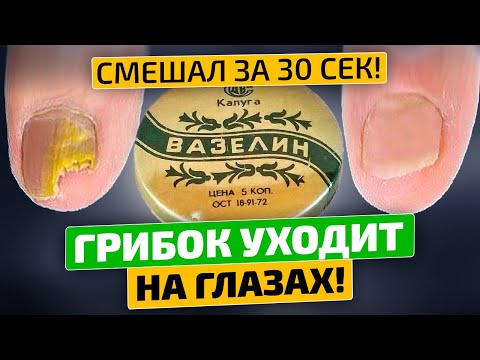 Видео: Грибок исчез! Кто придумал мешать вазелин с ...? За 2 раза помогло!