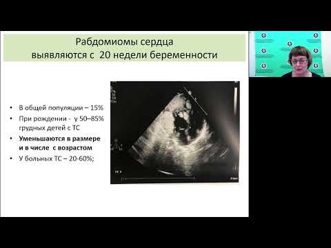Видео: Превентивная терапия эпилепсии при туберозном склерозе