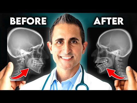 Видео: Могут ли брекеты или Invisalign на самом деле изменить форму вашего лица?