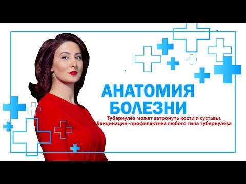 Видео: Туберкулёз может затронуть кости и суставы. Вакцинация -профилактика любого типа туберкулёза