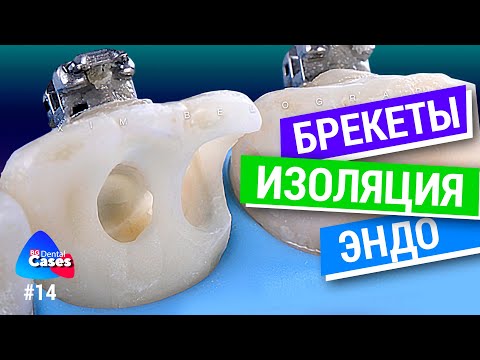 Видео: Брекеты, изоляция, эндо. Дентал кейсы от BG #14