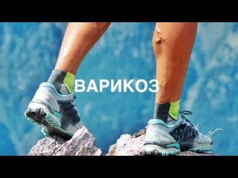 Видео: Как бегать с варикозом? Как от него избавиться?