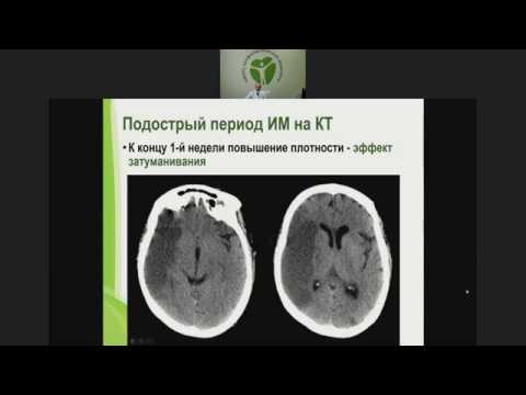Видео: Острые нарушения мозгового кровообращения ишемического характера