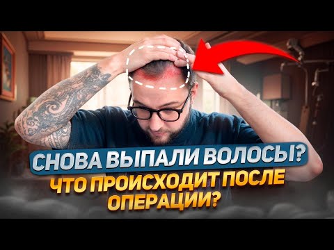 Видео: 3 месяца после пересадки волос: как проходит заживление?