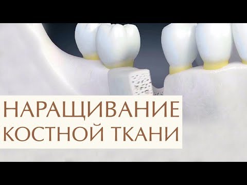 Видео: 💉  Костная пластика челюстей при имплантации зубов. Костная пластика челюсти. Легкое Дыхание. 12+