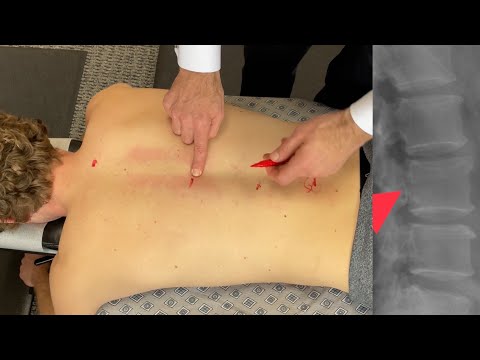 Видео: 25-летняя пациентка получила травму, которая изменила ее жизнь во время становой тяги? Осмотр ман...