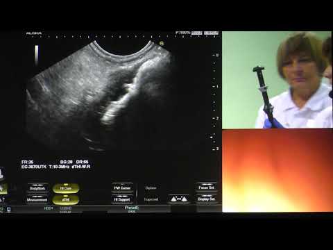 Видео: 21Live Солодинина ЕН Псевдокиста поджелудочной интрагастральное EUS дренирование стент HotAxios