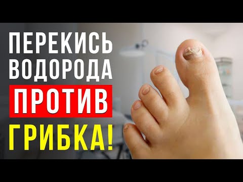Видео: МОЖНО ЛИ ВЫЛЕЧИТЬ ГРИБОК НОГТЕЙ ПЕРЕКИСЬЮ ВОДОРОДА? МНЕНИЕ ПОДОЛОГА! УЗНАЙ ПРАВДУ ПРЯМО СЕЙЧАС