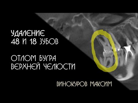 Видео: Удаление зубов мудрости и отлом бугра. Максим Винокуров