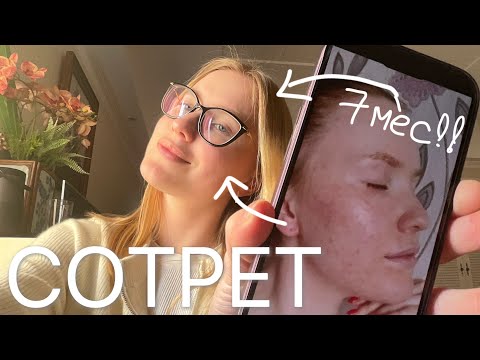 Видео: Сотрет:как я избавилась от акне за 7-8месяцев