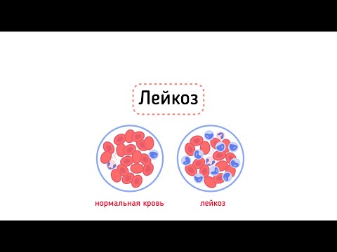 Видео: Острый и хронический лейкозы. Примеры анализов.