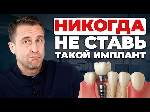 Видео: Все виды ЗУБНЫХ ИМПЛАНТОВ в 1 видео! Какой имплант выбрать в 2026 году?