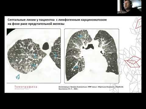 Видео: Септальные линии (утолщение междольковых перегородок)