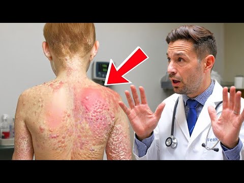 Видео: Мальчик Думал, Что У Него Клопы. Но Врач Присмотрелся — И Ужаснулся!