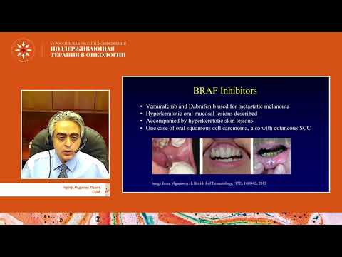 Видео: Осложнения со стороны полости рта при проведении противоопухолевой терапии