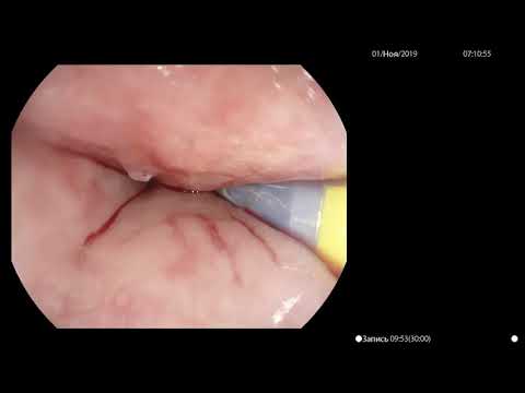 Видео: Стентирование пищевода саморасширяющимся нитиноловым стентом