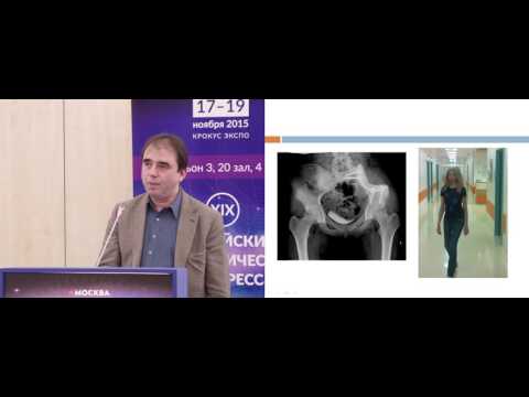 Видео: Функциональные результаты хирургического лечения пациентов с опухолевой патологией костей таза