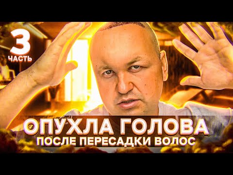 Видео: Опухла голова | Третий день после пересадки волос | Моя история трансплантации волос