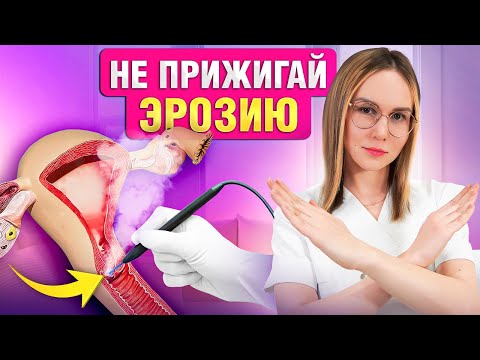 Видео: Эрозия шейки матки. Лечить или не лечить?