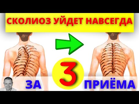 Видео: Вся правда о сколиозе. Сколиоз не приговор! Доктор Аверьянов рекомендует.