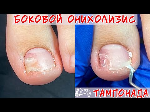 Видео: Онихолизис на ногах / Последствия неудобной обуви