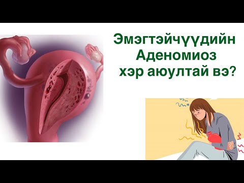 Видео: умайн салст хэт зузаарах эмгэг гэж юу вэ?