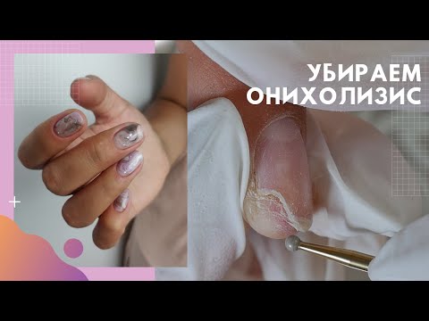 Видео: Вернулась с ОНИХОЛИЗИСОМ 👌 ПРОТЕЗИРОВАНИЕ ногтя. Маникюр из Инстаграм «Натуральные текстуры»