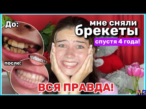 Видео: МНЕ СНЯЛИ БРЕКЕТЫ СПУСТЯ 4 ГОДА! вся правда || потратила 300,000₽ на зубы