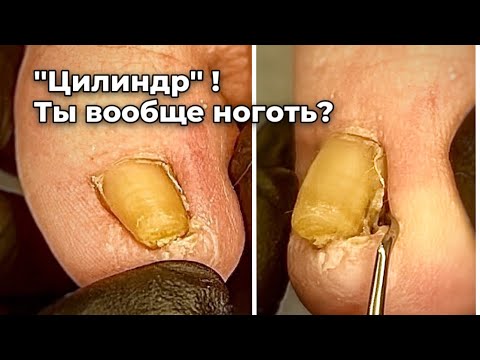 Видео: Скрутившийся ноготь с врастающими боковыми стенками сдавил ногтевое ложе.