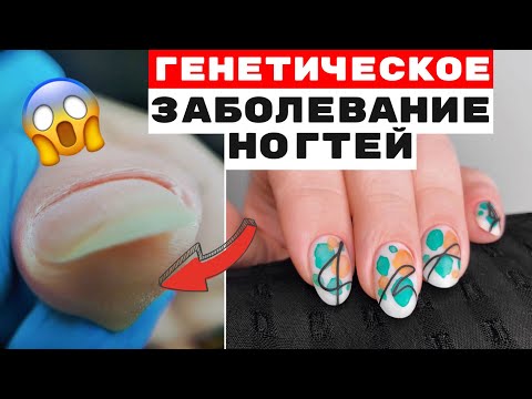 Видео: Генетическая болезнь ногтей😱 Исправление формы ногтей