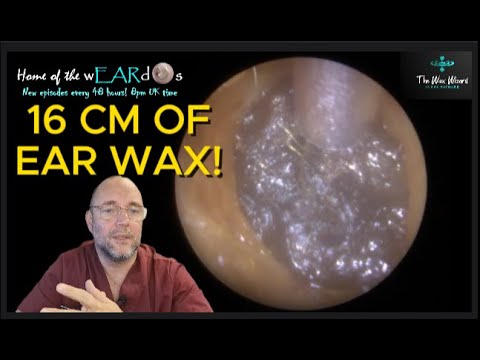 Видео: 16 СМ УШНОЙ СЕРЫ! 199 #ухо #ушнаясера #удалениеушнойсеры #чисткаушей #асмр #асмрушнаясера #удовле...